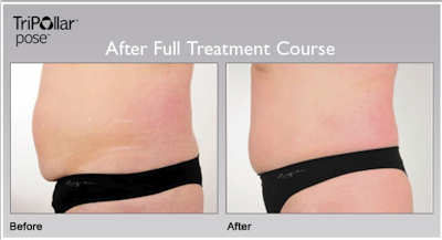 Tripollar Pose abdominals before and after photos